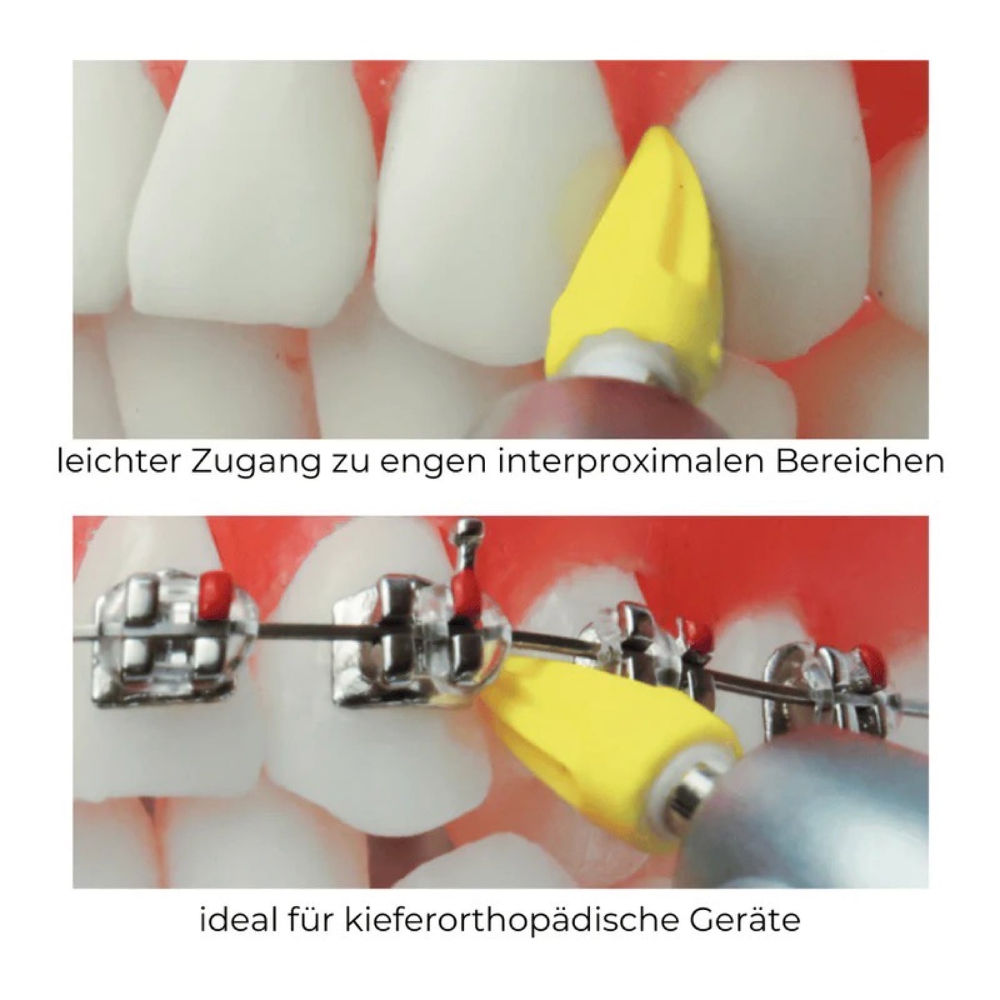 Silikon-Polierspitzen Screw-In, spitz & geriffelt, mittel, latexfrei 100 St. / Pck.